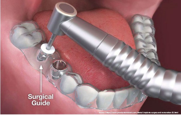 Guided-Implant-Surgery